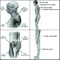 Upper Cross Lower Cross Syndrome Total Therapy Physiotherapy Massage Therapy Burnaby