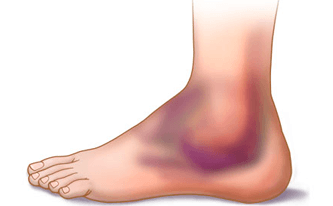 Ankle Sprain Total Therapy Physiotherapy Massage Therapy Burnaby